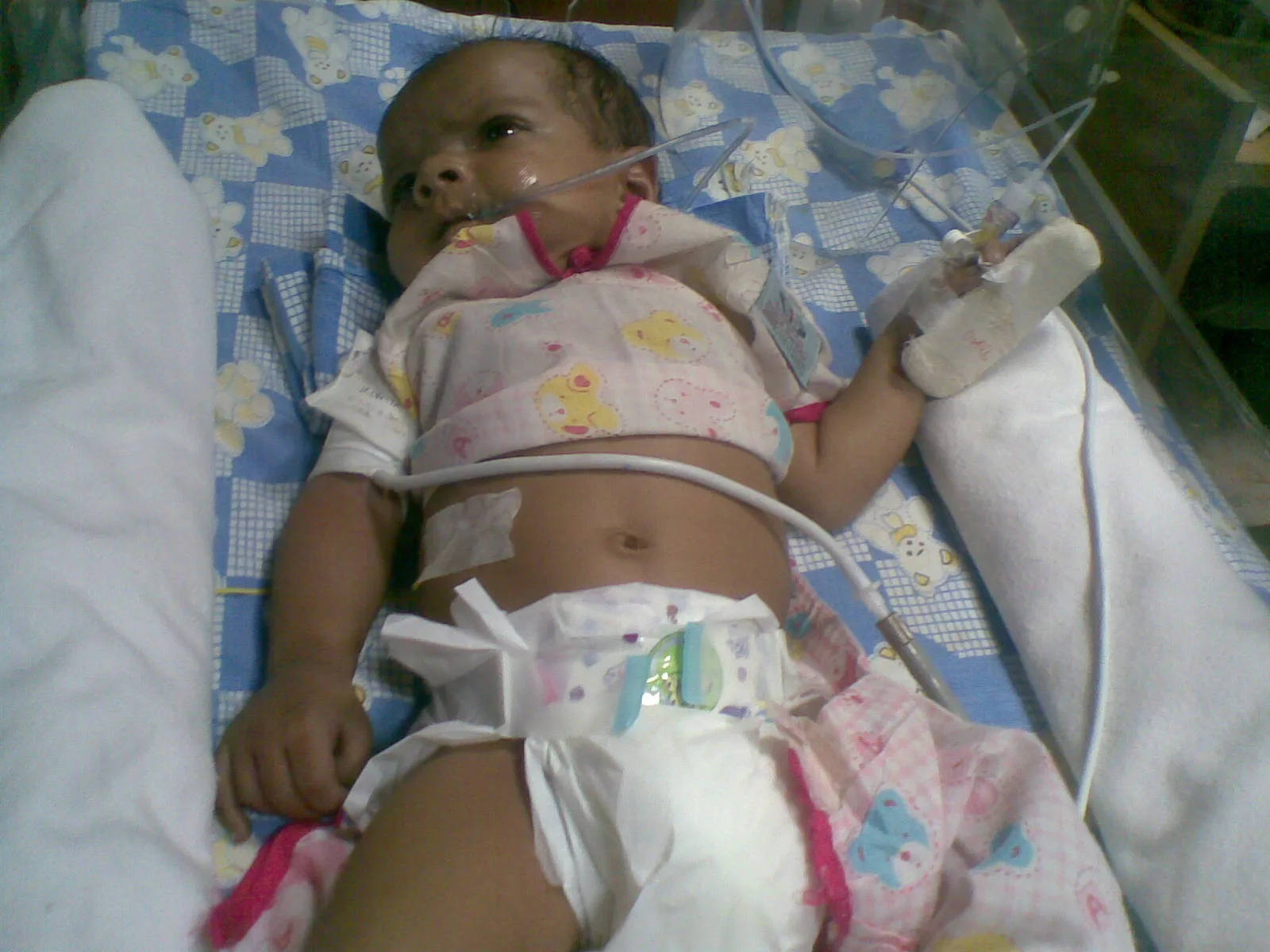 UNUSUAL CASE OF BLUE BABY SYNDROME (METHEMOGLOBINEMIA ) IN A NEONATE  DUE TO WATER CONTAMINATION