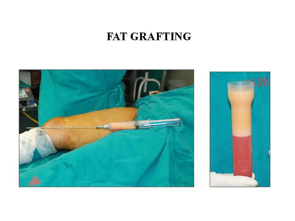 ANOTHER BREAKTHROUGH SURGERY BY SIR GANGA RAM HOSPITAL DOCTORS TEAM..