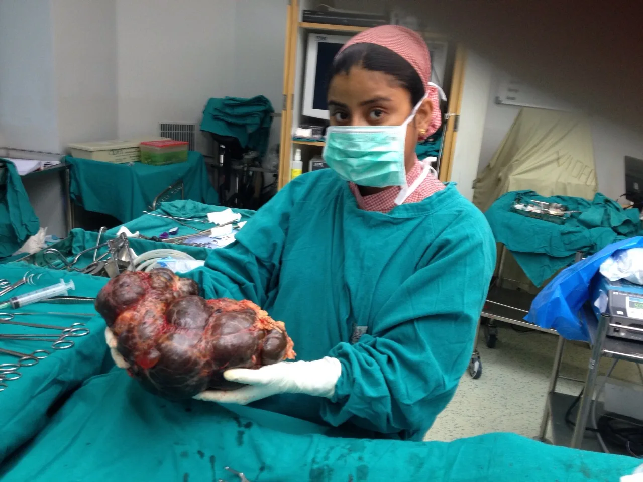 WORLD’S LARGEST KIDNEY REMOVED AT SIR GANGA RAM HOSPITAL