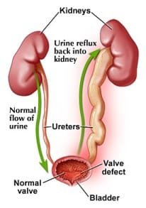 PERSISTENT UTI SYMPTOMS MAY POINT TO BLADDER CANCER