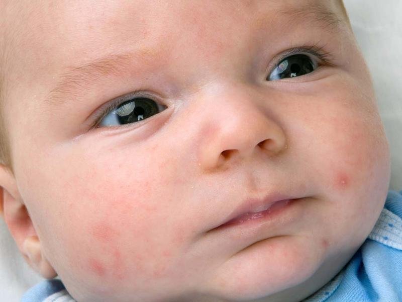 Tips to protect children from rashes this summer season