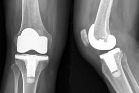 Joint replacement surgeons hailed government’s decision to cap the prices of knee implants