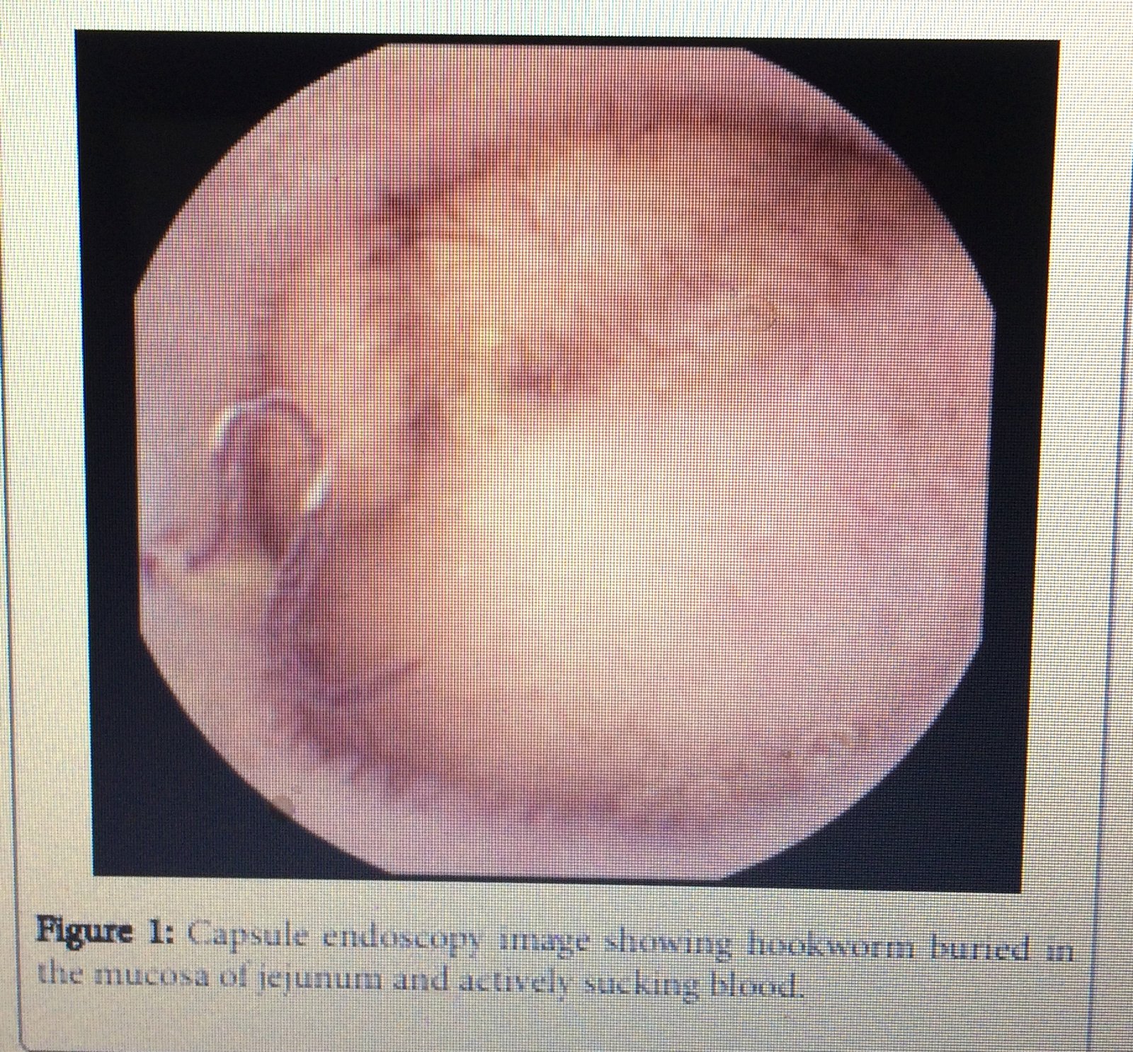 DANCING HOOKWORMS SUCK 22 LITRES BLOOD IN A 14 YR BOY