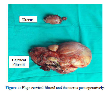 Giant Cervical Fibroid equal to 9 months of foetus removed by unique “Hybrid Technique” by SGRH doctors.