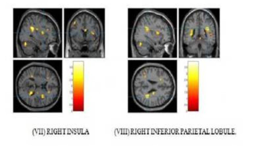 Supervised mindfulness meditation benefits patients with Mild Cognitive Impairment & early Alzheimer’s disease