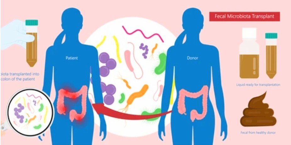 YOUR POOP CAN CURE SOMEONE’S DISEASE SOUNDS OUTRAGEOUS BUT IT IS TRUE