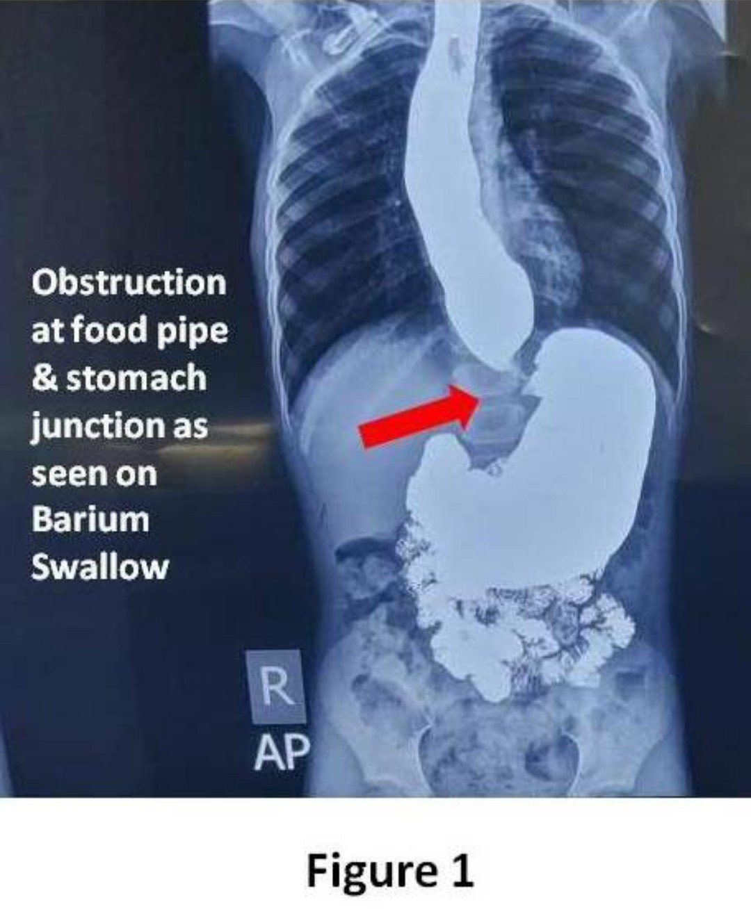 YOUNGEST PATIENT IN INDIA UNDERGOES REMOVAL OF OBSTRUCTION IN FOOD PIPE BY SPECIAL ENDOSCOPIC PROCEDURE CALLED POEM (PER ORAL ENDOSCOPIC MYOTOMY)