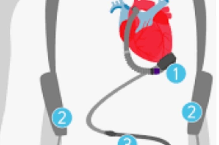 Army Hospital (R&R) performs India’s first-ever Left Ventricular Assist Device implantation using HeartMate 3 device in a government institution